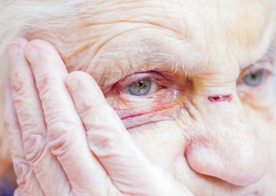 Close,Up,Picture,Of,An,Injured,Elderly,Woman’s,Eyes,&
